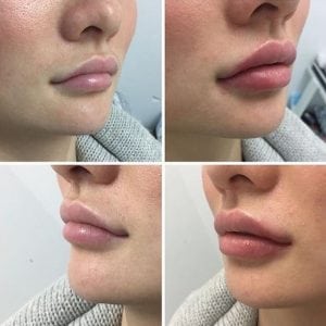 Prefilled Syringe Lip Augmentation Filler Fast Recovery Significant Effect