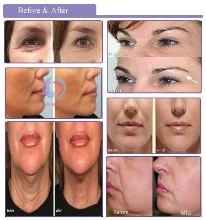 Bi Direction COG Skin Threading Face Lift Non Surgical Immediate Effect