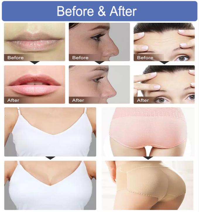 Temporary Skin Effects Dermal Filler Fine Derm Non Surgical Lip Filler