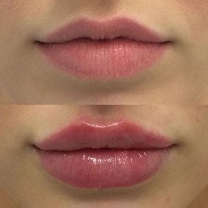 Beauty Safety Lip Augmentation Filler Liquid Gel Cosmetic Lip Injections